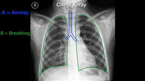 Chest xray result.